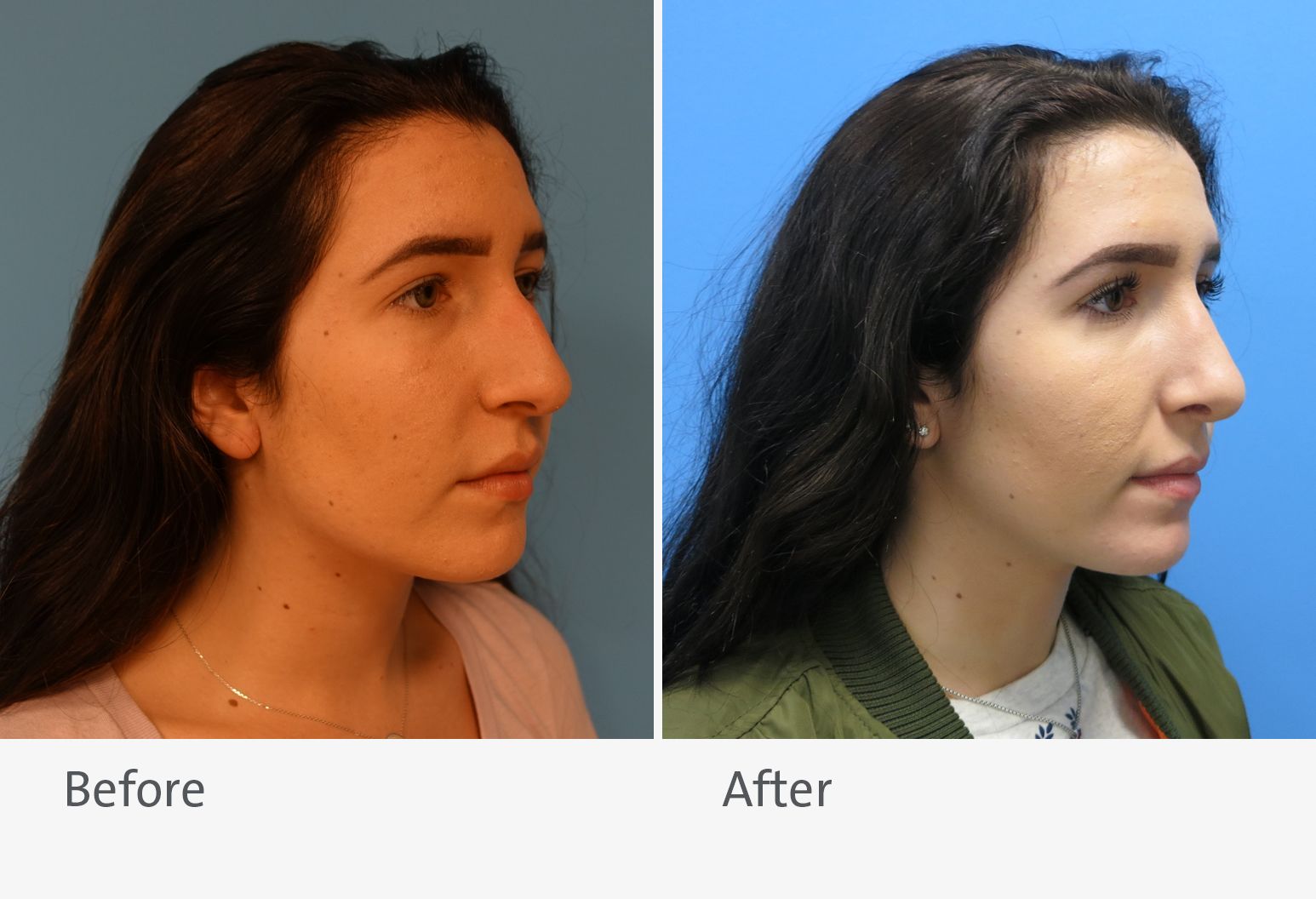 A patient is shown before and after rhinoplasty surgery. On the left is the patient before surgery and on the right is the patient after surgery.